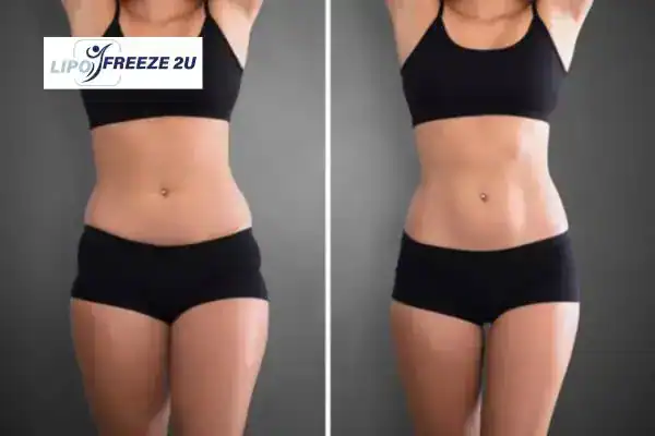 How Can LIPO FREEZE 2U Support Your Post-Pregnancy Body Recovery Shropshire?