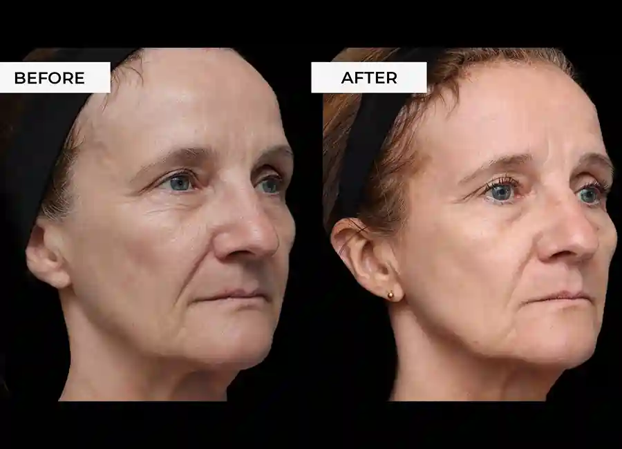 How Many RF Microneedling Sessions Will You Need to See a Difference Shropshire?