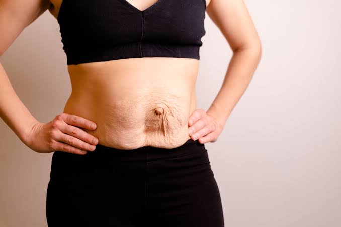 Is Surgery Really the Only Way to Repair Diastasis Recti Shropshire?
