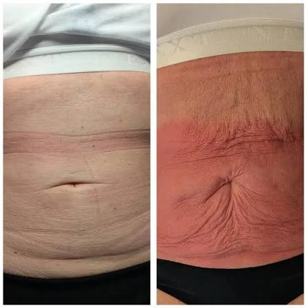 How Does RF Microneedling Improve Crepey, Thin and Uneven Skin Texture Shropshire?