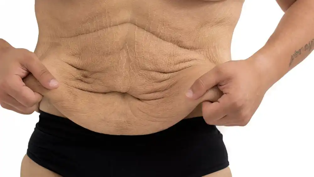 RF Microneedling for Loose Skin: How Can It Help Tighten and Reshape the Skin Shropshire?